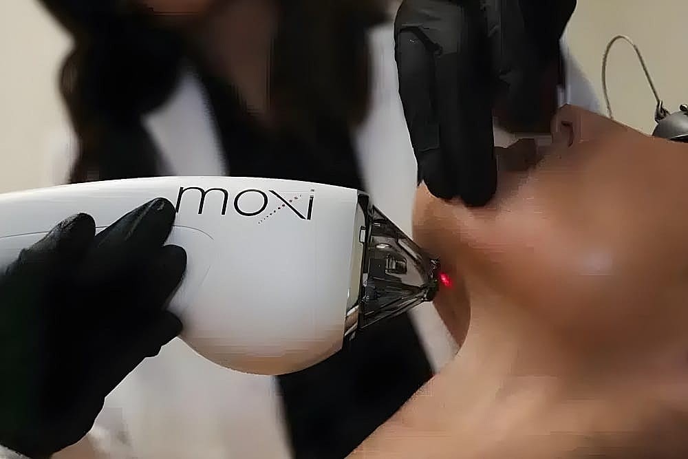 How A Moxi® Treatment Can Help Your Skin