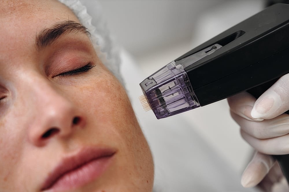 Microneedling vs. Moxi Laser: Which Is Best for Acne Scars in Salt Lake City
