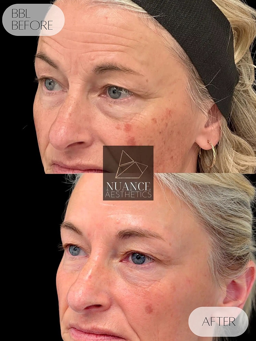 Bbl Laser Before & After
