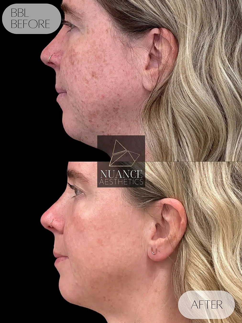 Bbl Laser Before & After