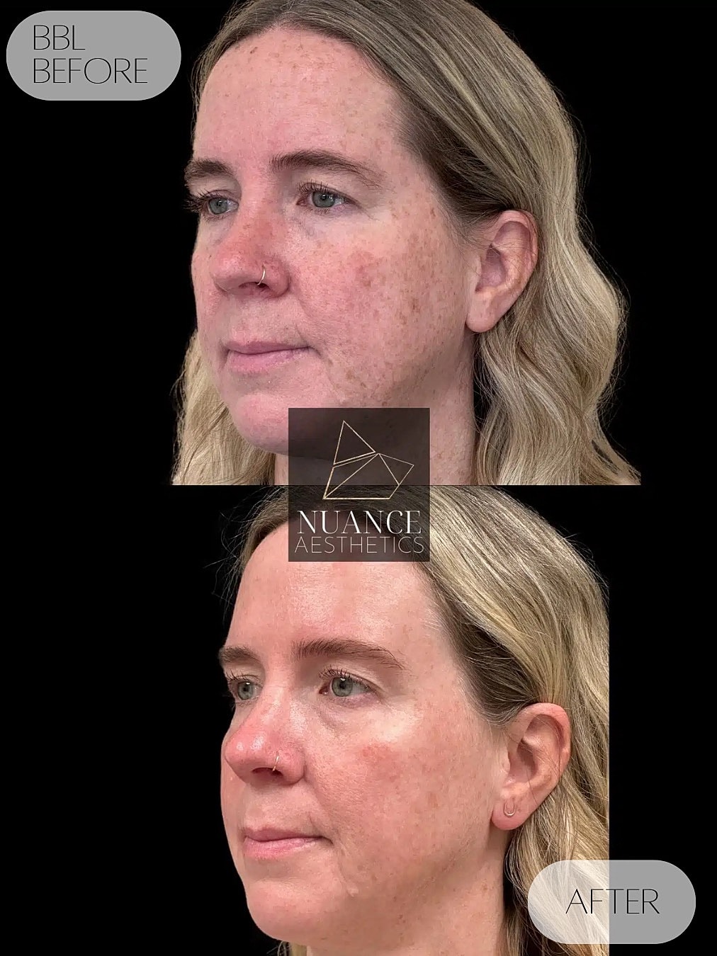 Bbl Laser Before & After