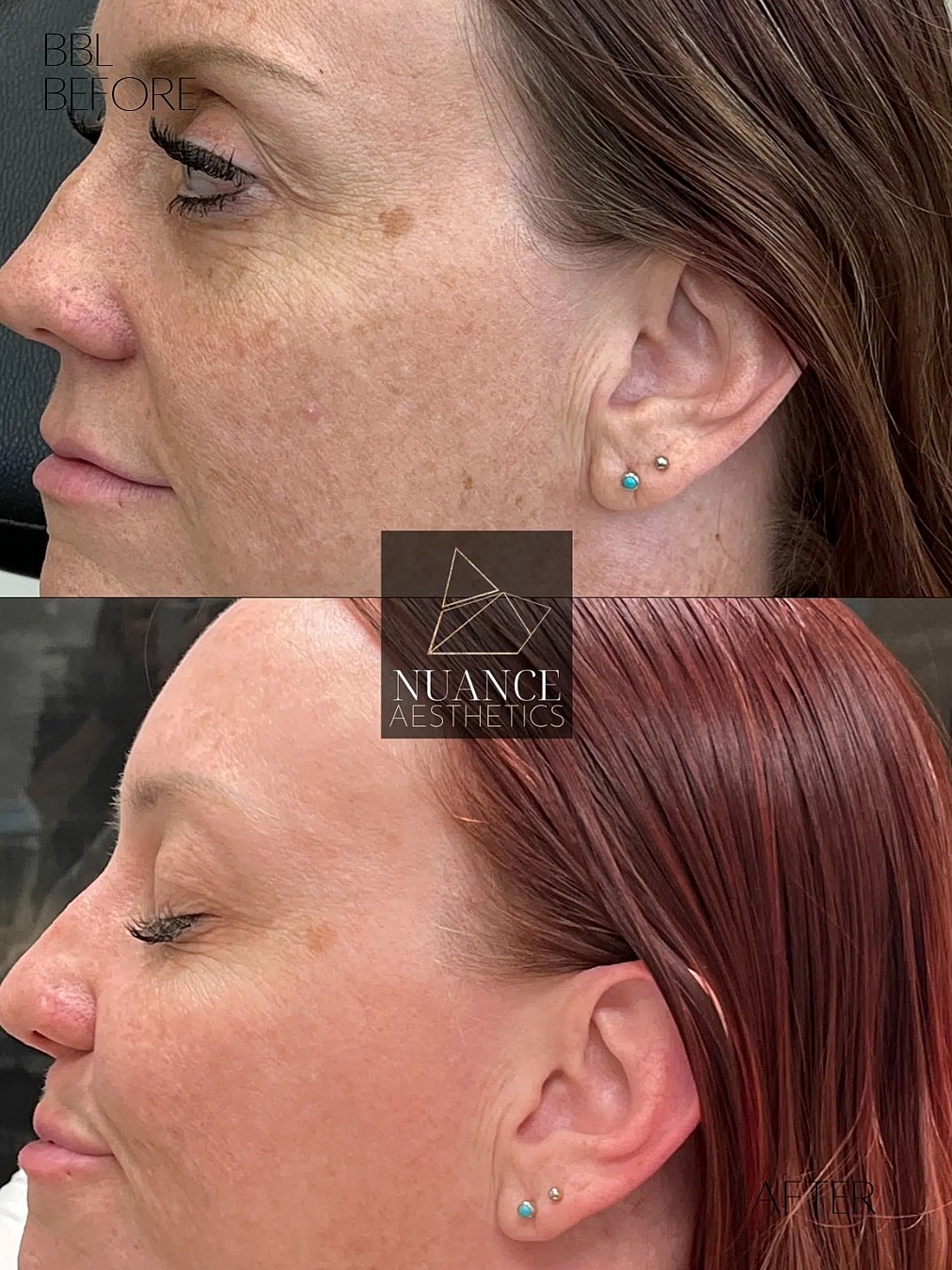 Bbl Laser Before & After