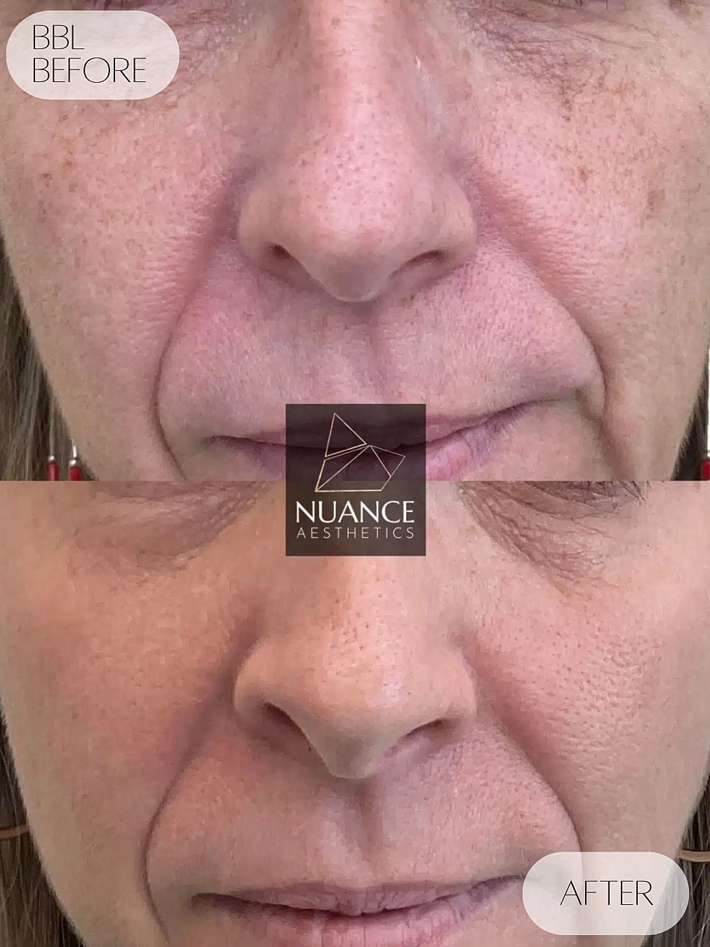 Bbl Laser Before & After