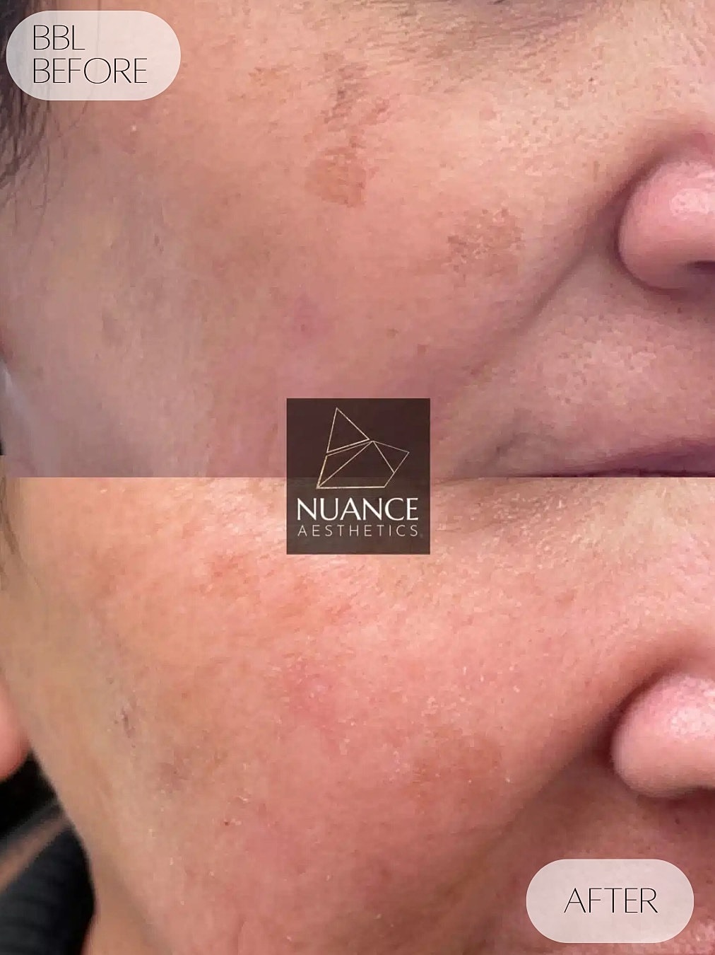 Bbl Laser Before & After
