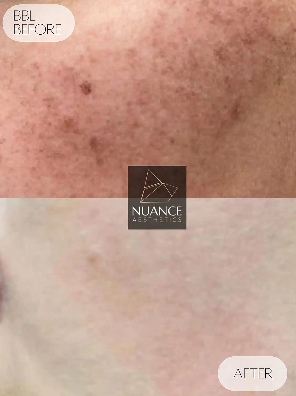 Bbl Laser Before & After