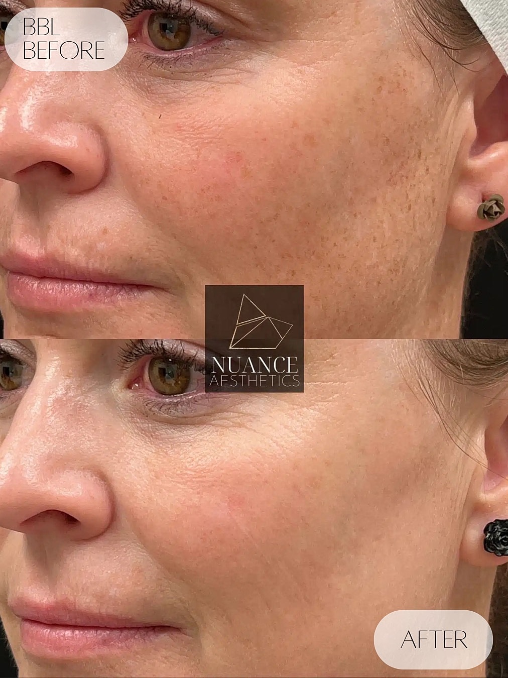 Bbl Laser Before & After