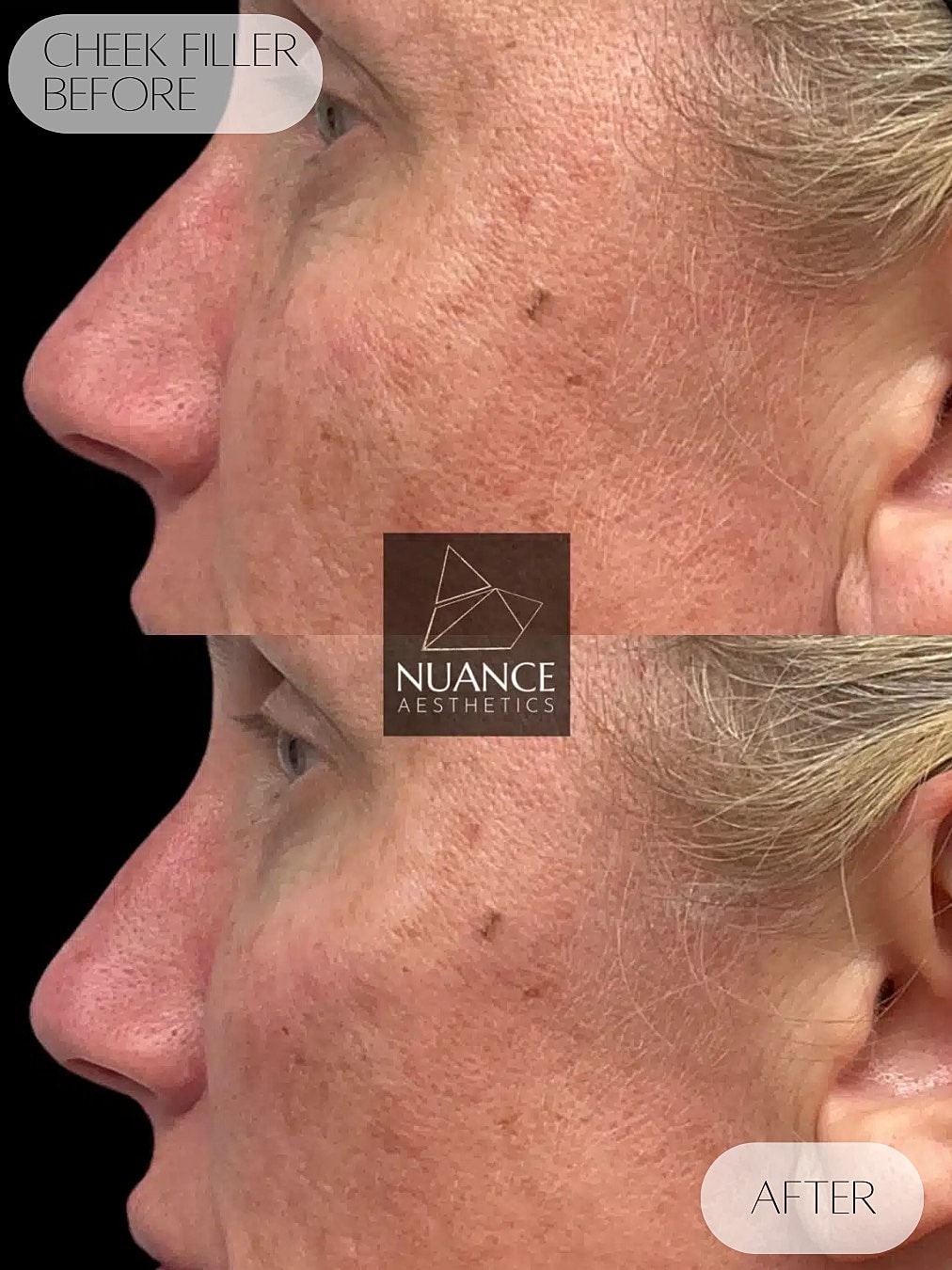 Cheek Filler Before & After