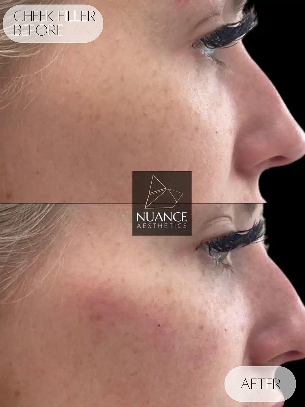Cheek Filler Before & After