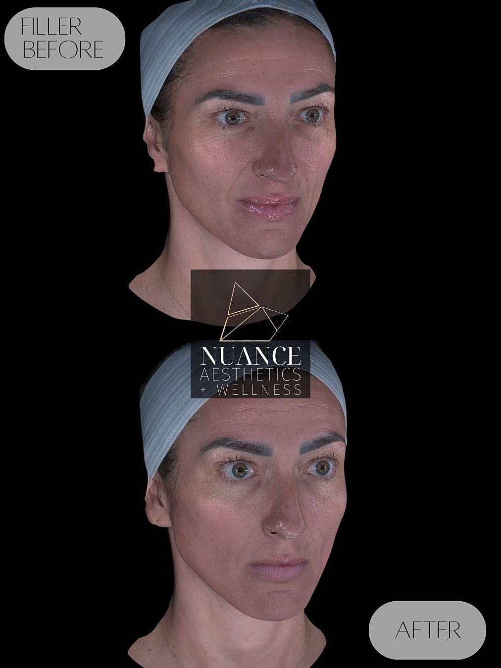 Cheek Filler Before & After