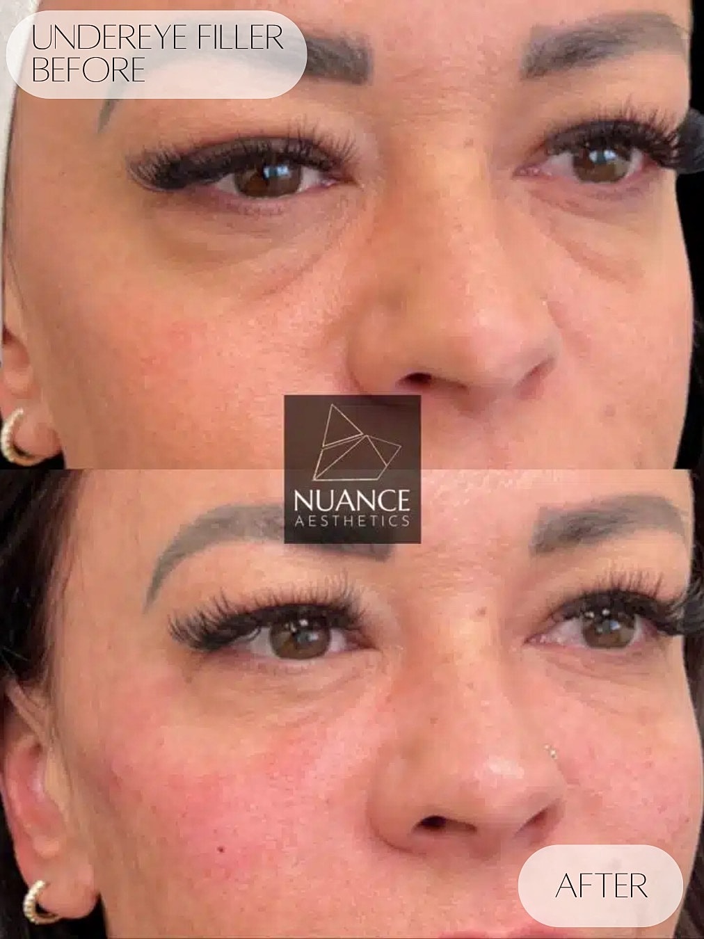 Under Eye Injections Before & After