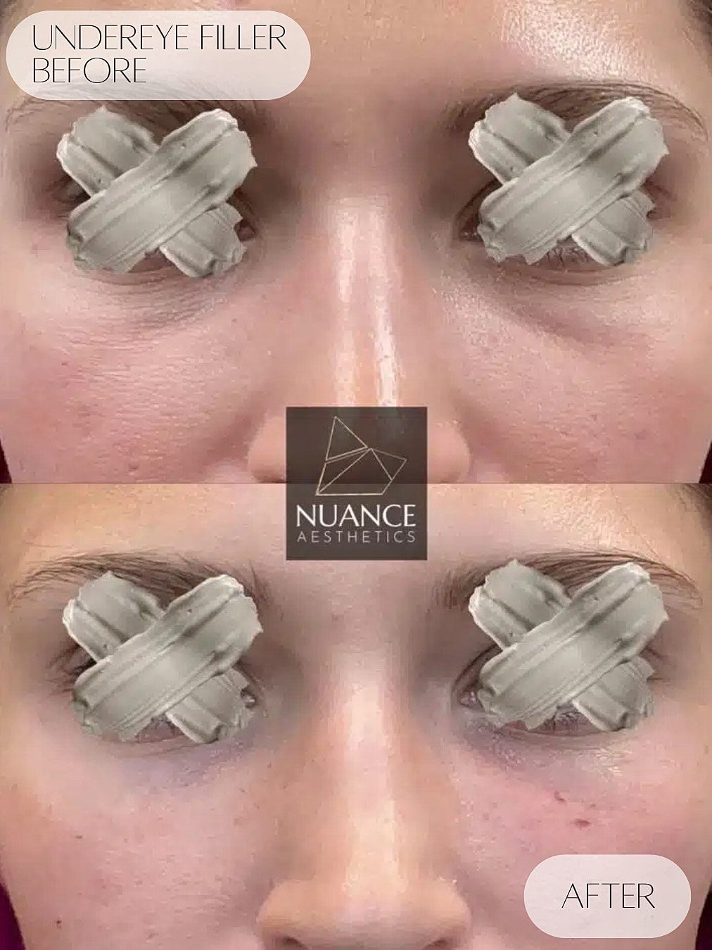 Under Eye Injections Before & After