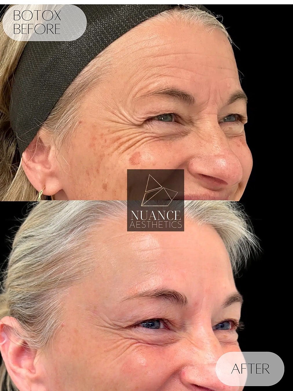 Botox Before & After