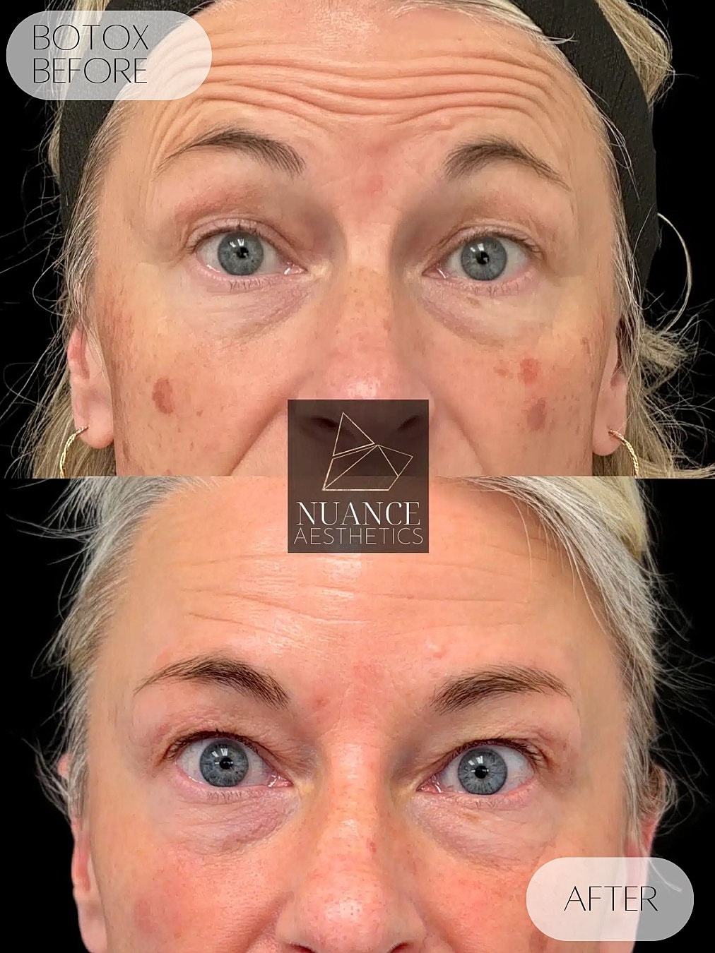 Botox Before & After