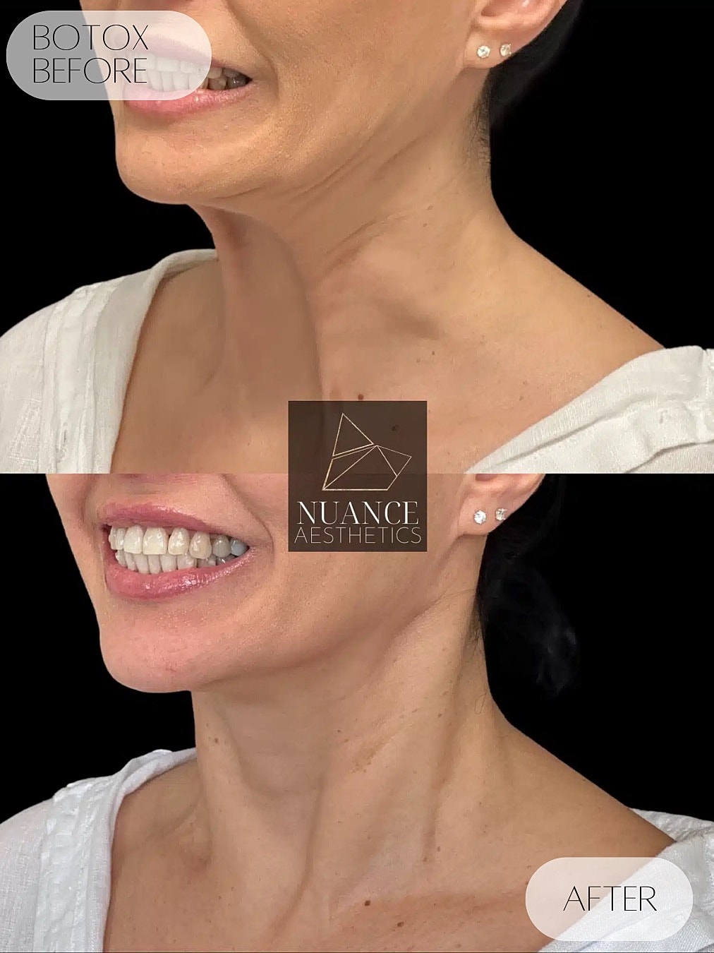 Botox Before & After