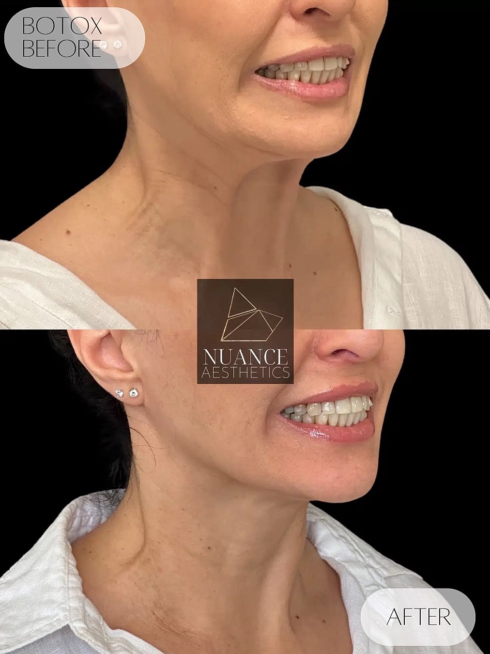 Botox Before & After