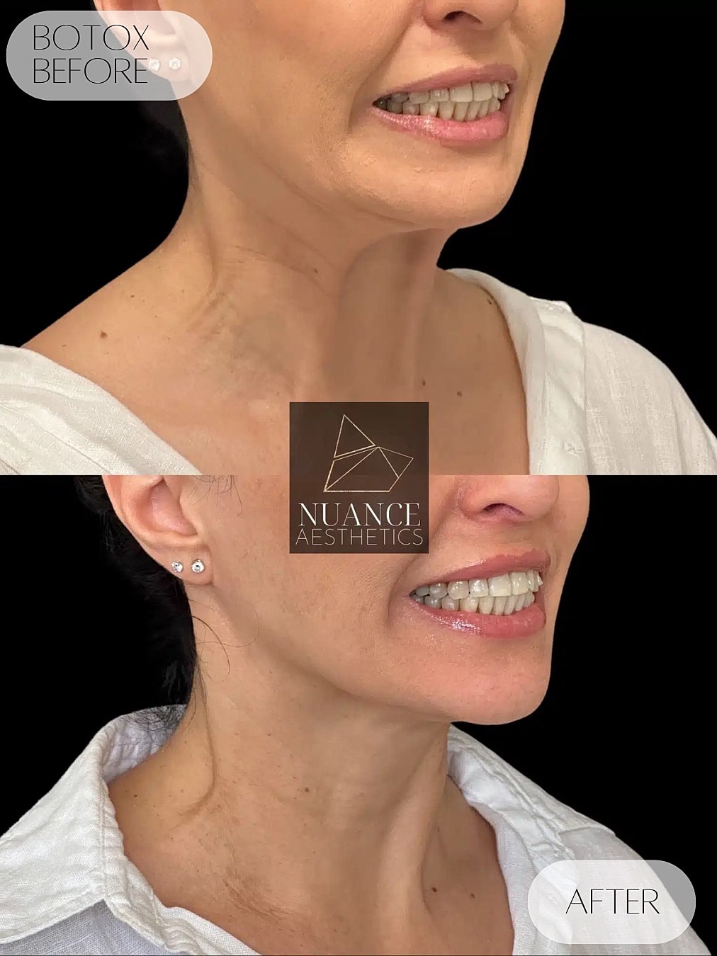Botox Before & After