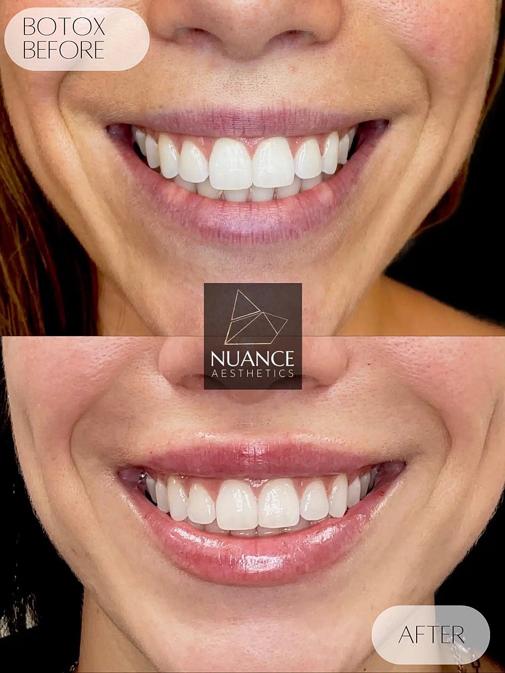 Botox Before & After