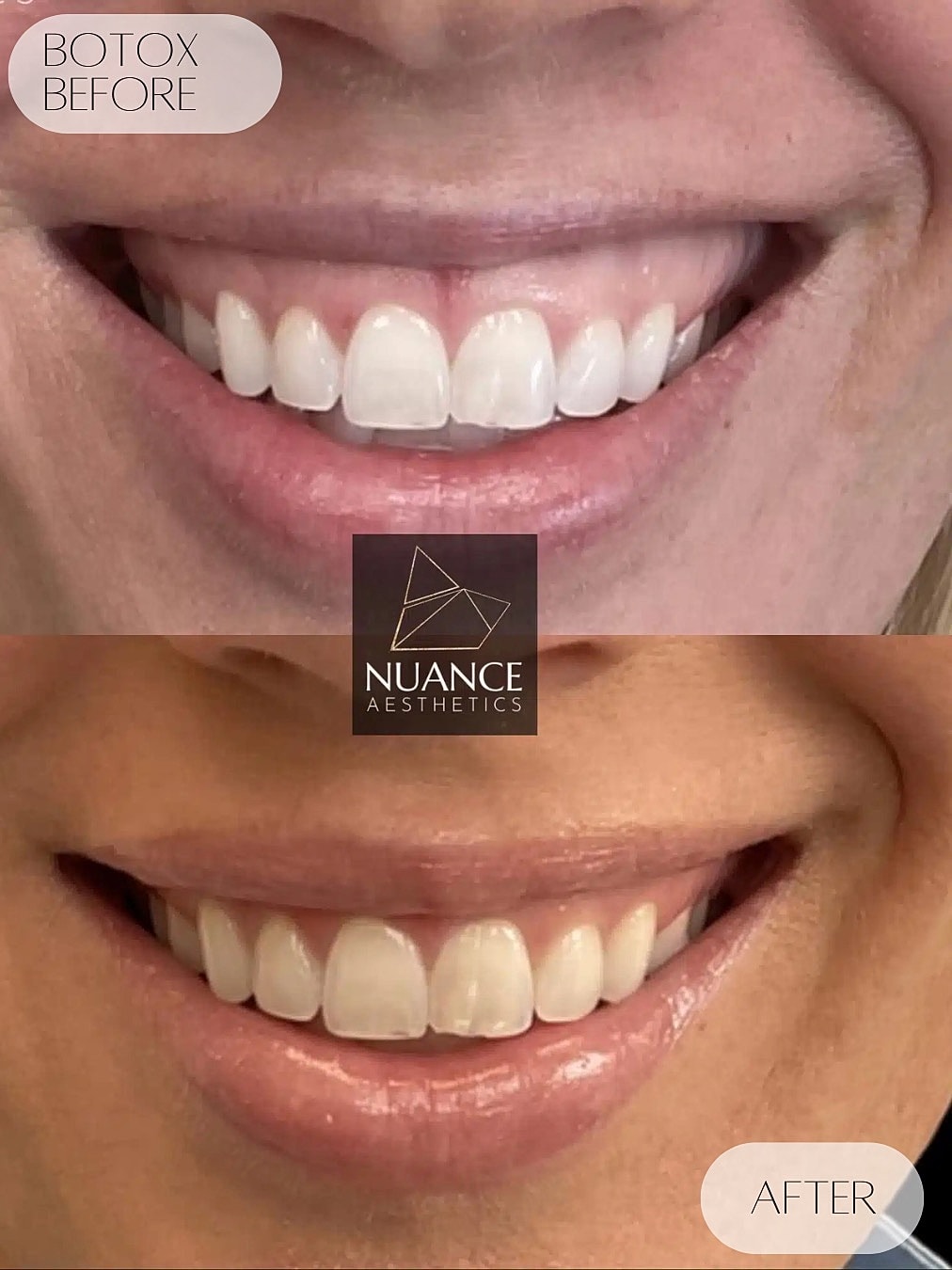Botox Before & After
