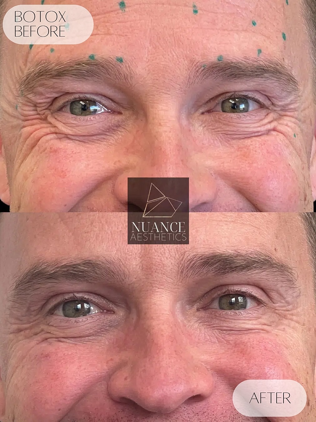 Botox Before & After