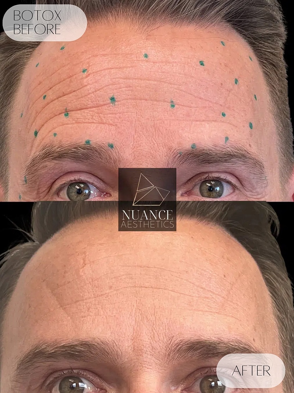 Botox Before & After