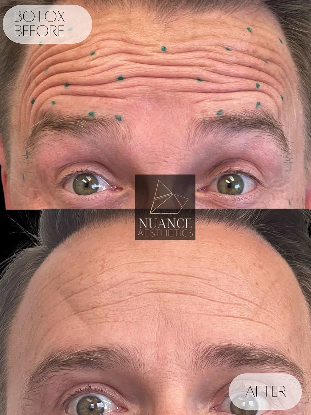 Botox Before & After