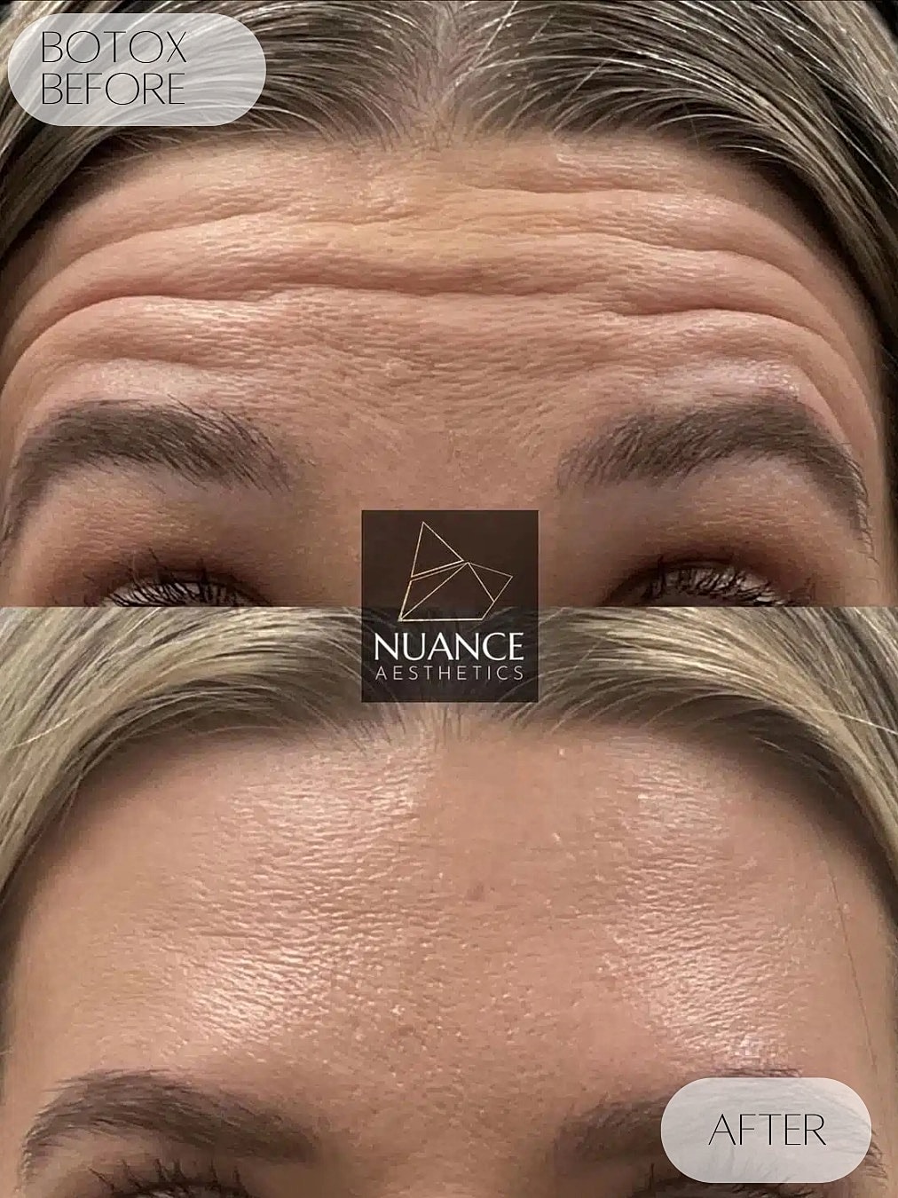 Botox Before & After