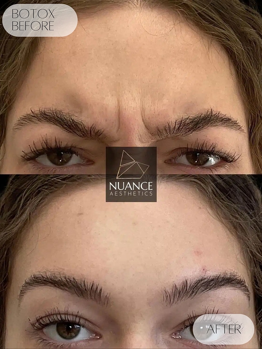 Botox Before & After
