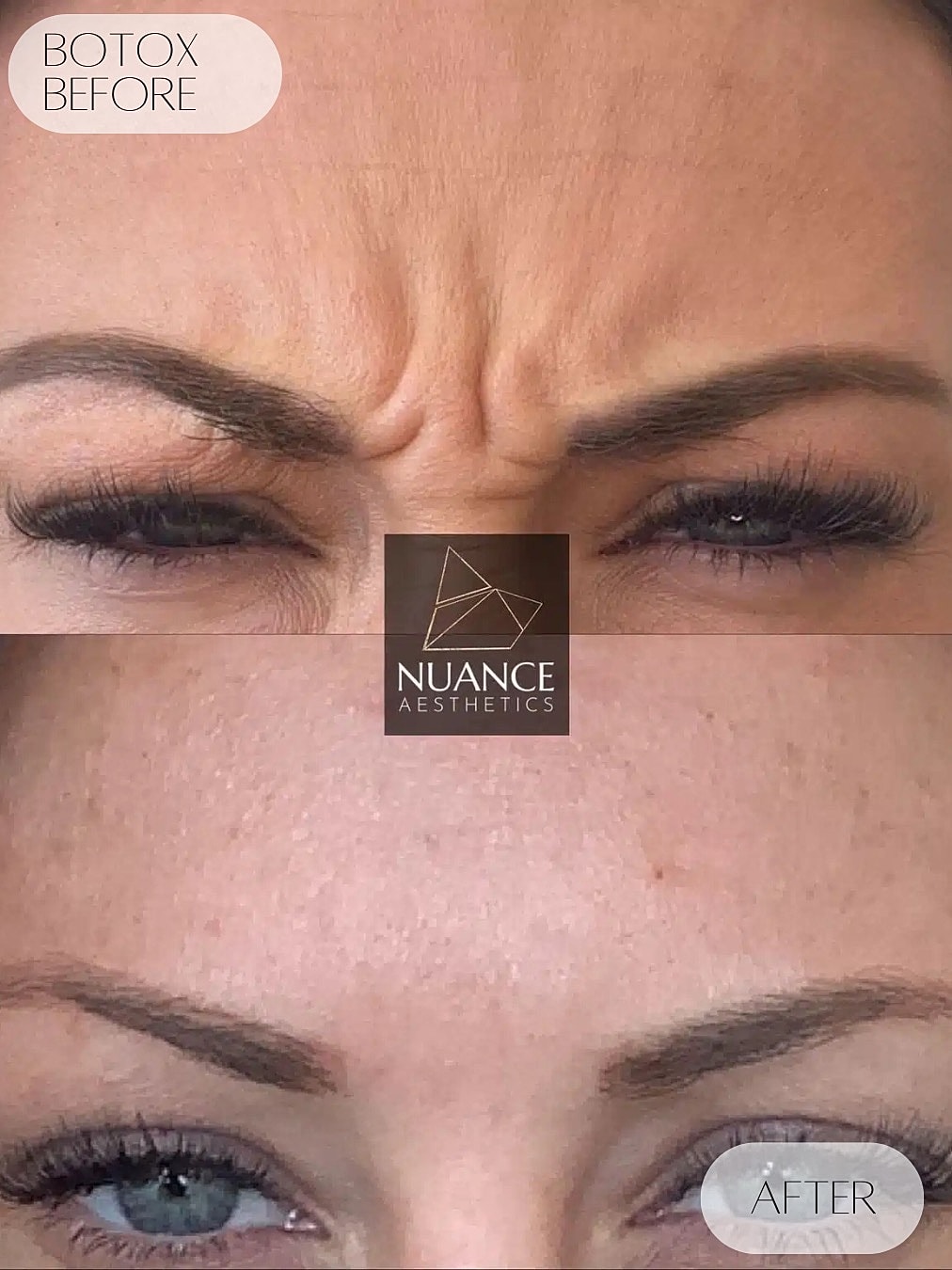 Botox Before & After