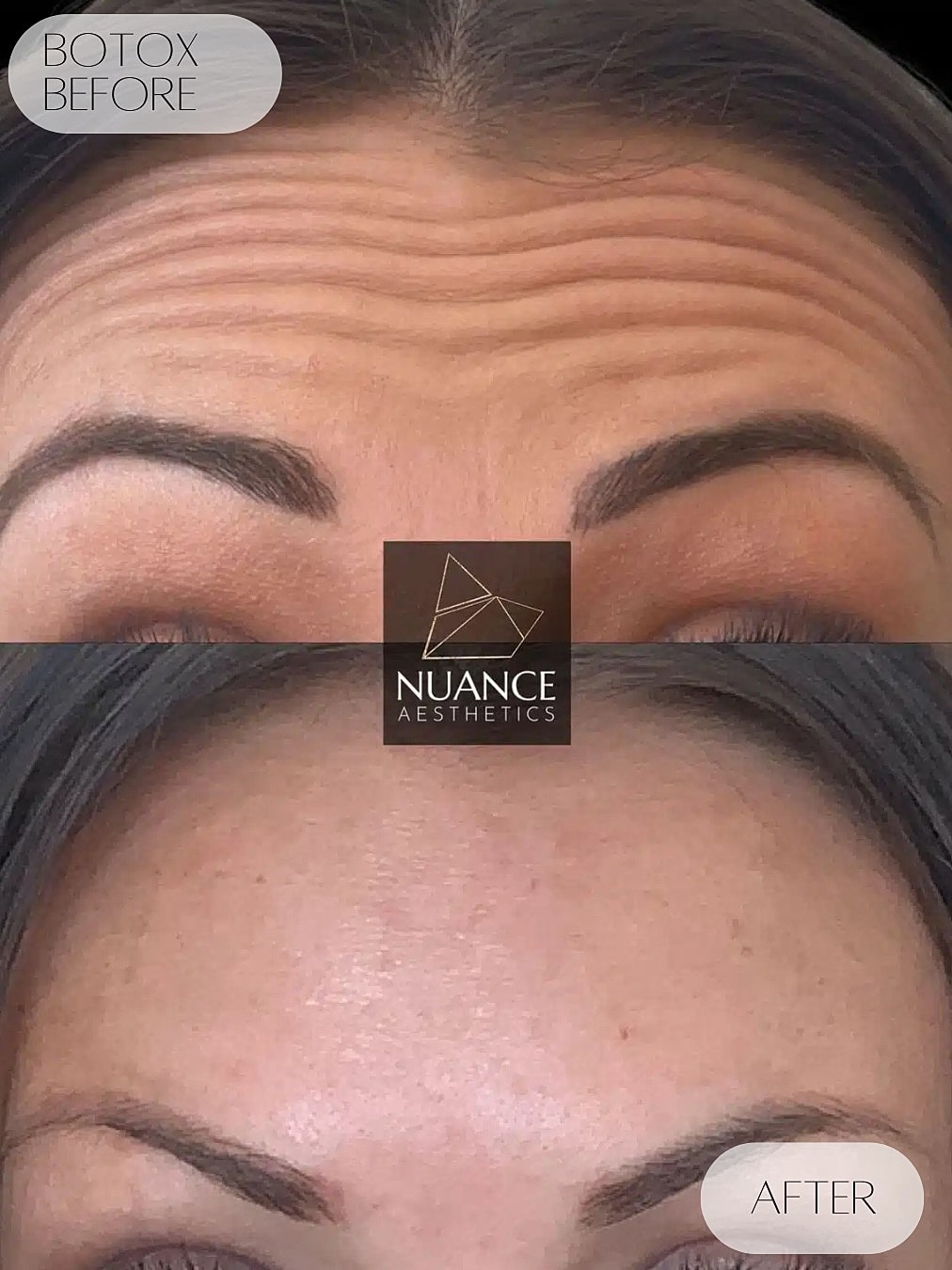 Botox Before & After