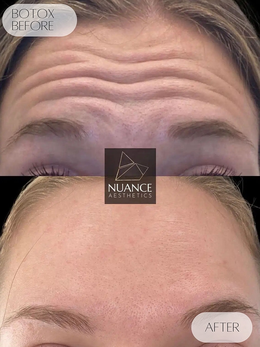 Botox Before & After