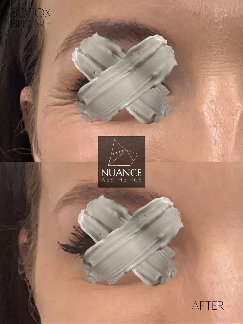 Botox Before & After