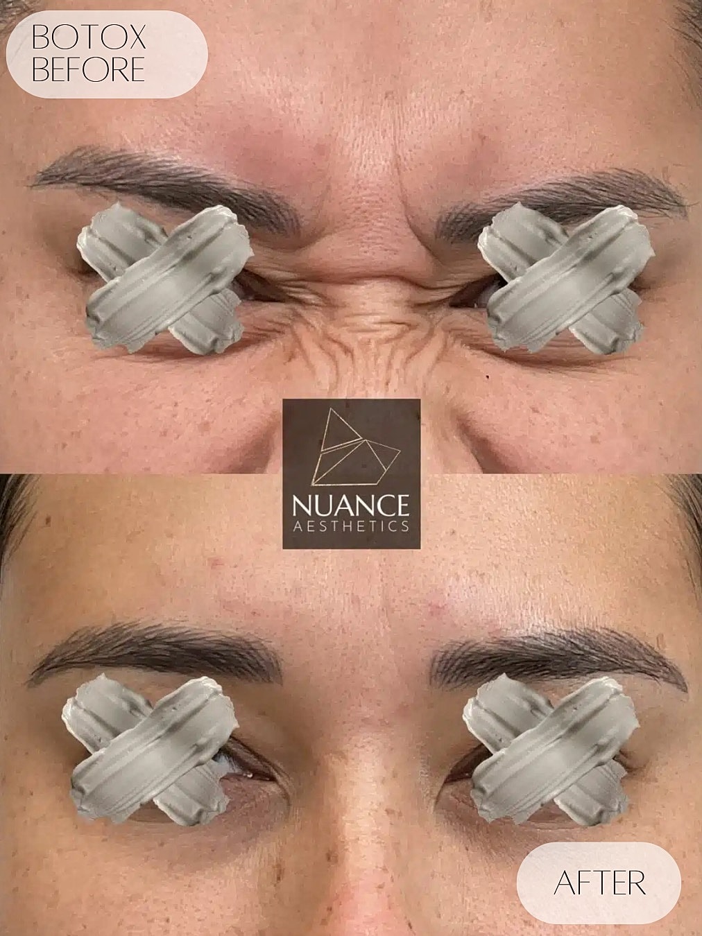 Botox Before & After