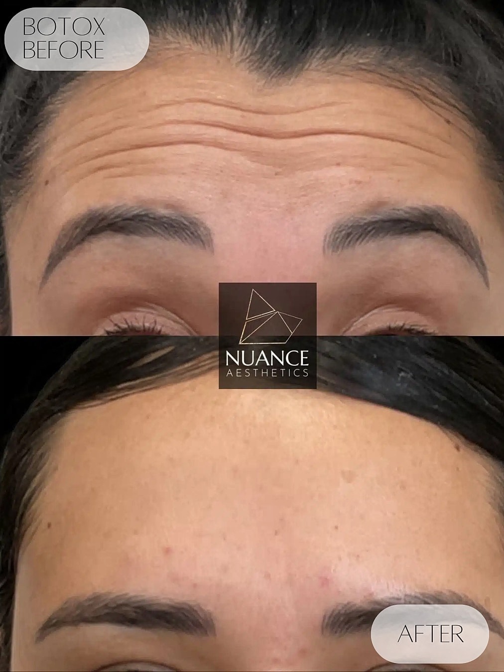 Botox Before & After