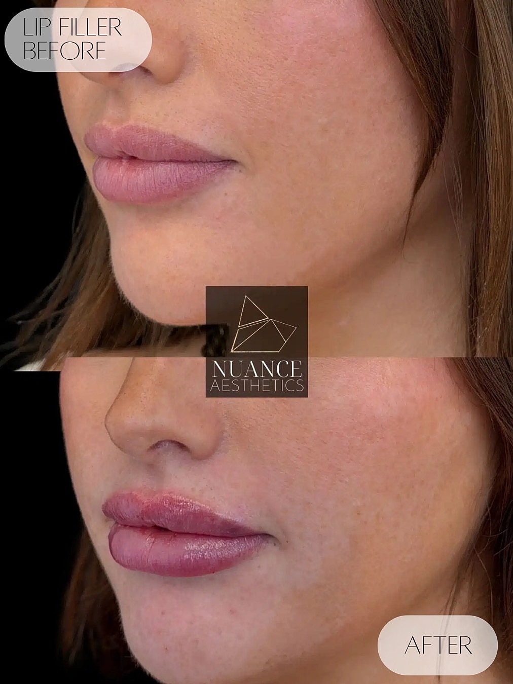 Lip Filler Before & After