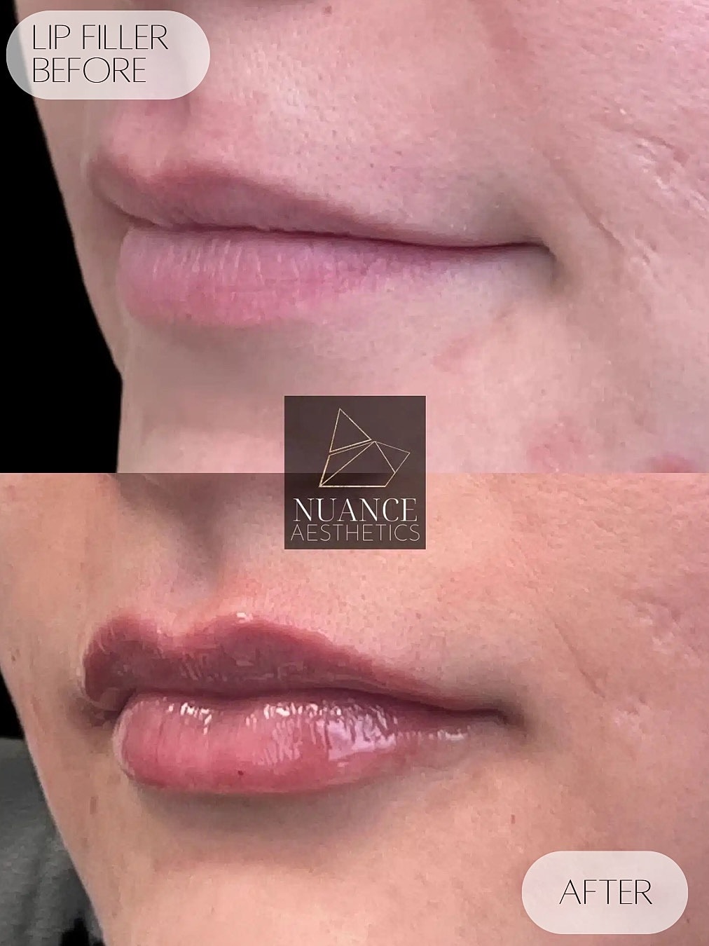 Lip Filler Before & After