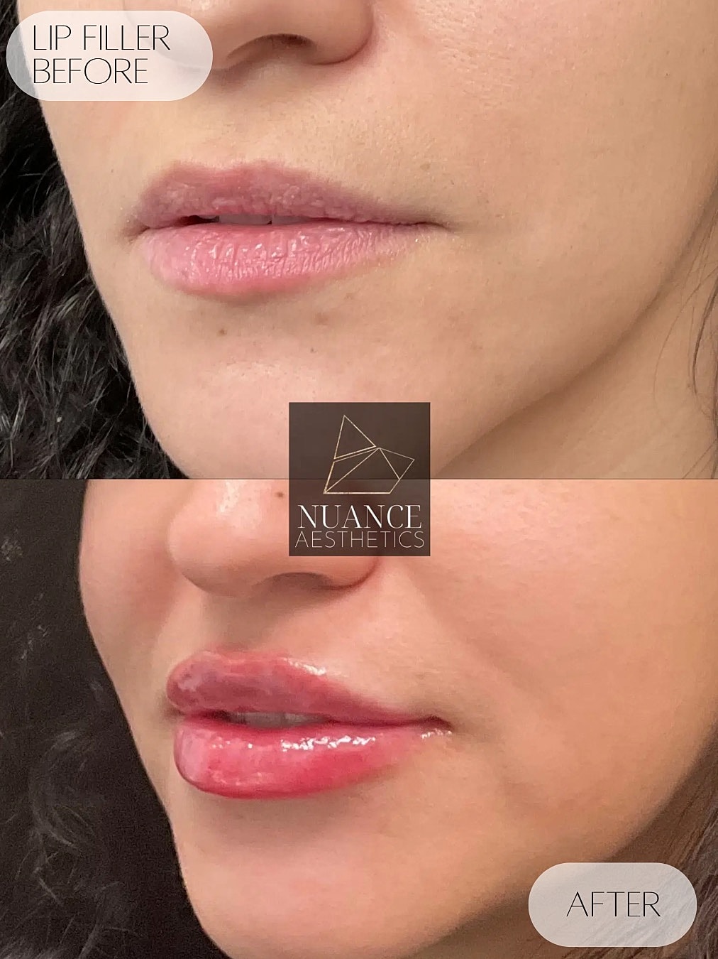 Lip Filler Before & After
