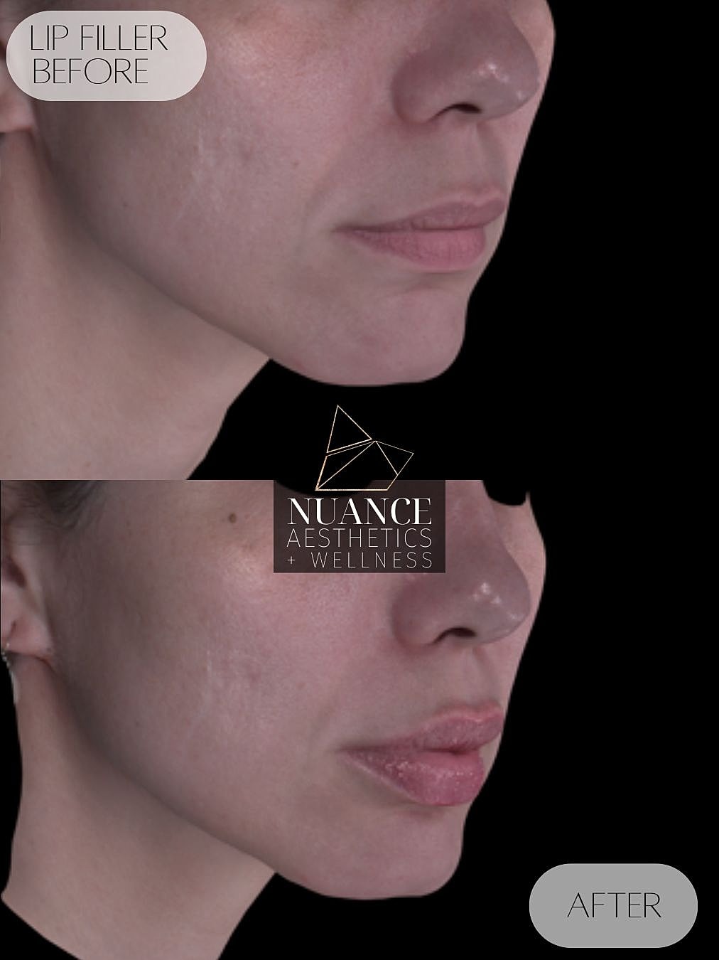 Lip Filler Before & After
