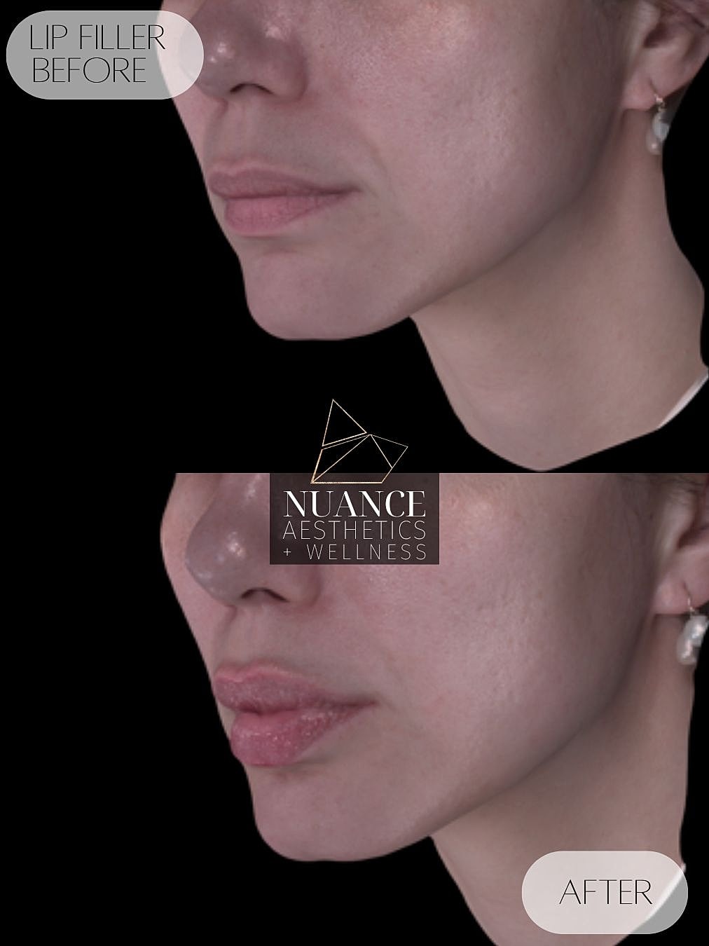 Lip Filler Before & After