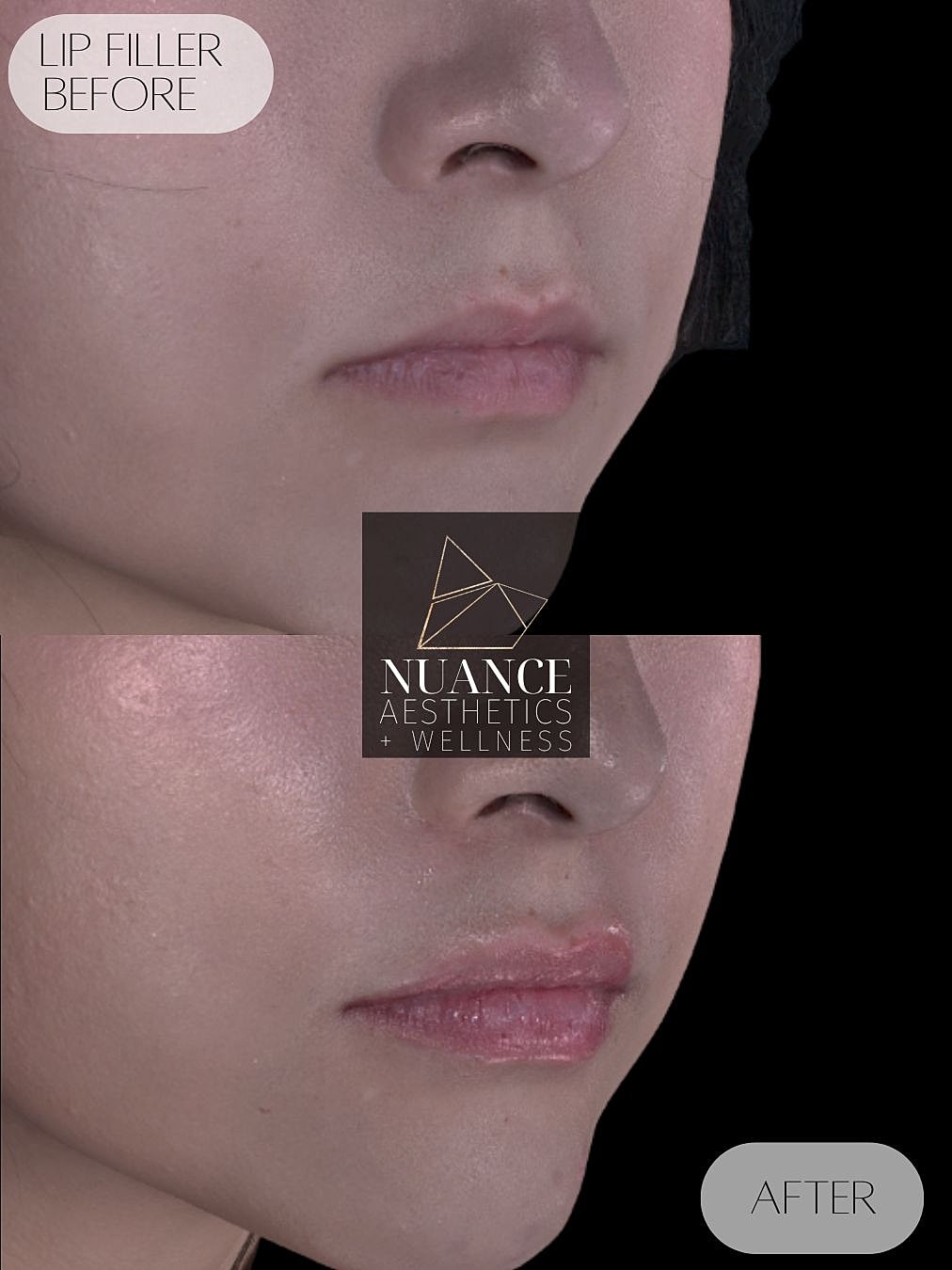 Lip Filler Before & After