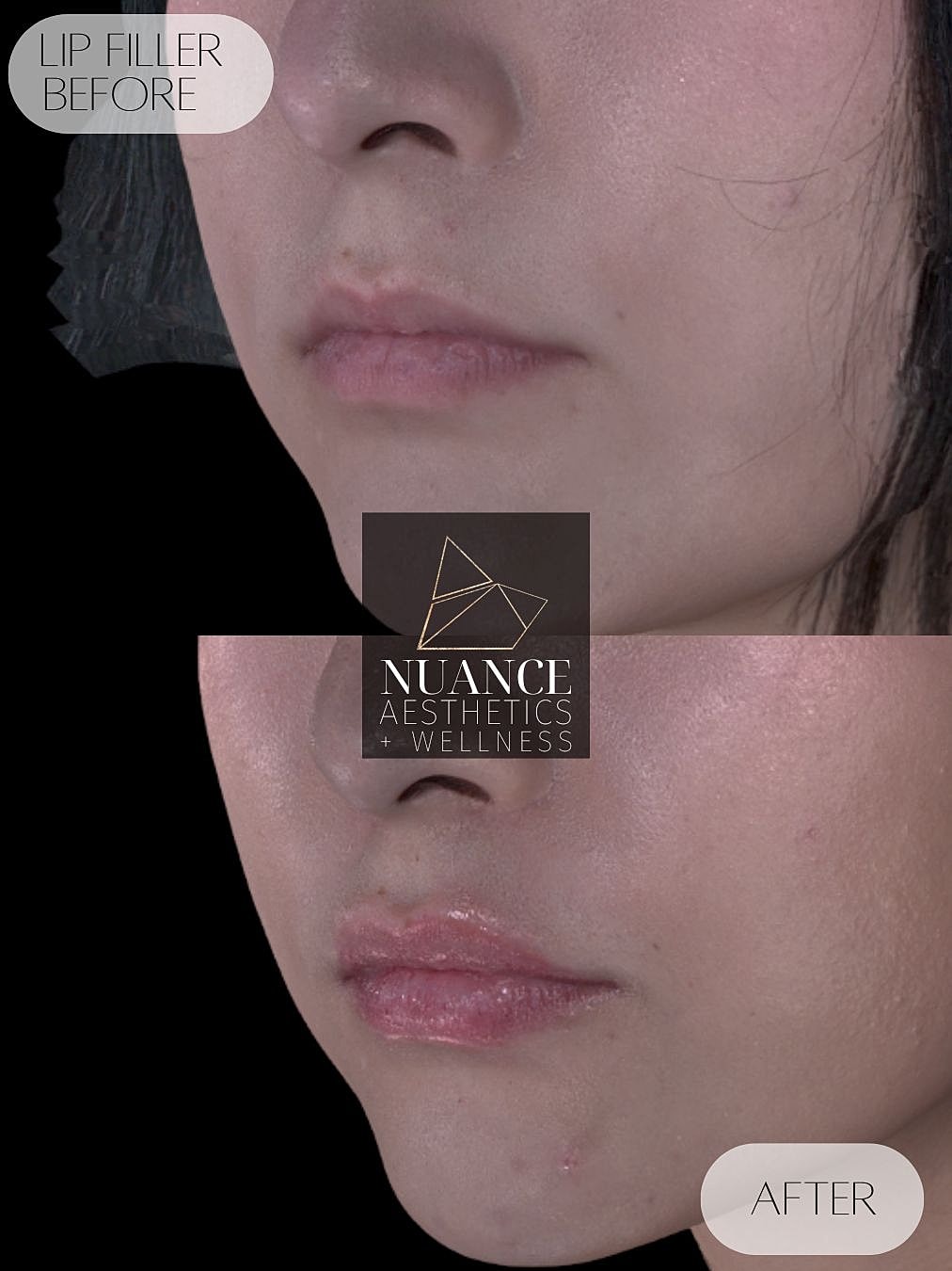 Lip Filler Before & After