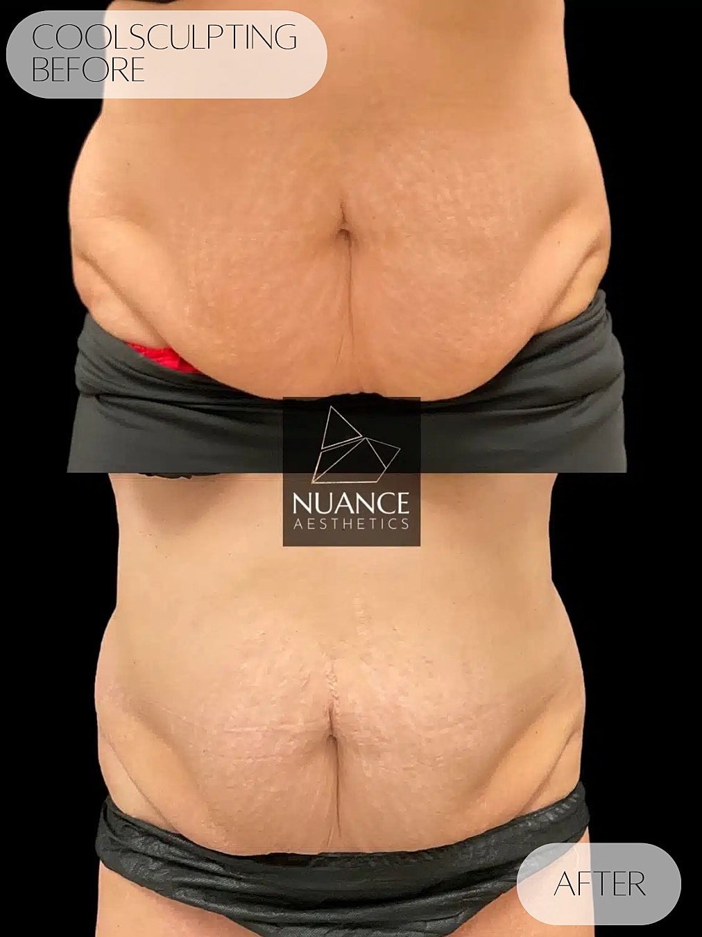 Coolsculpting Before & After