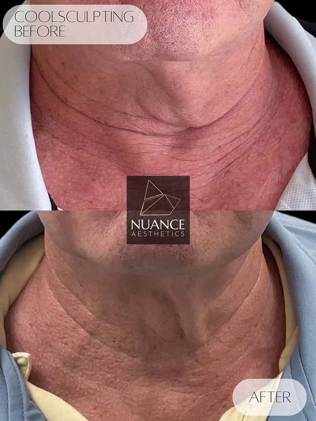 Coolsculpting Before & After