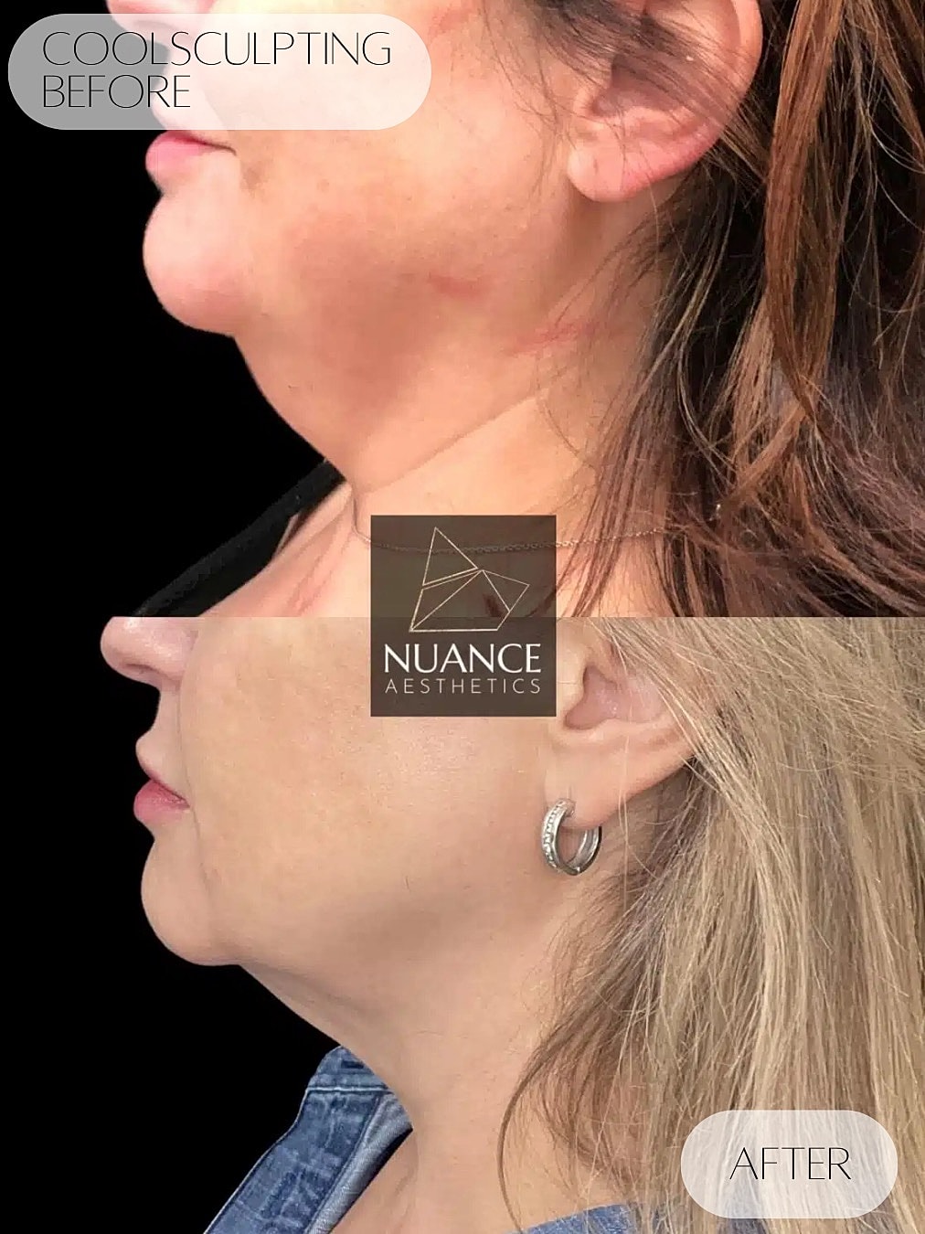 Coolsculpting Before & After