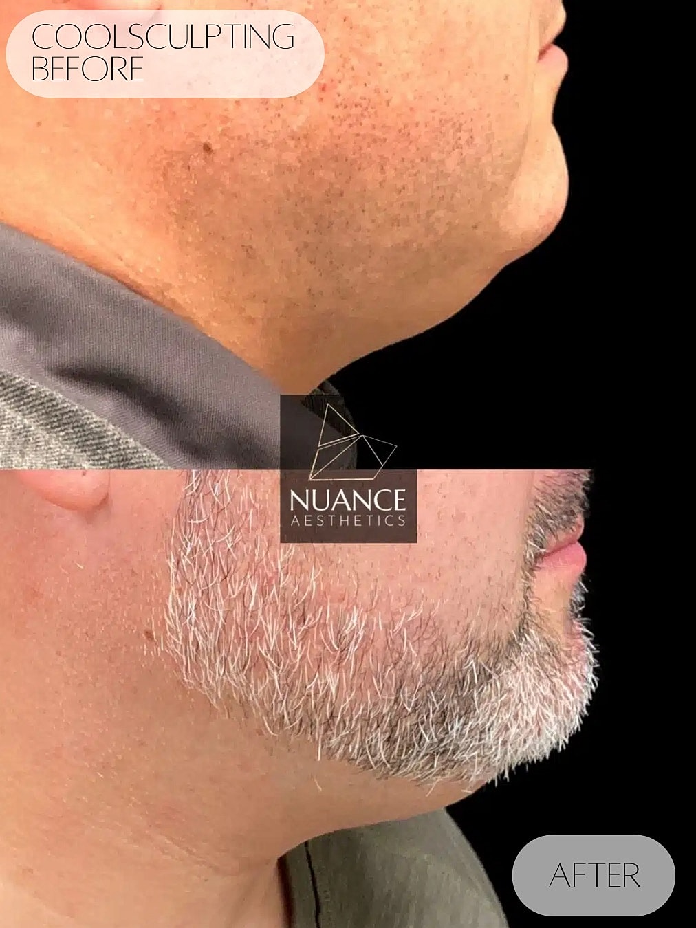 Coolsculpting Before & After