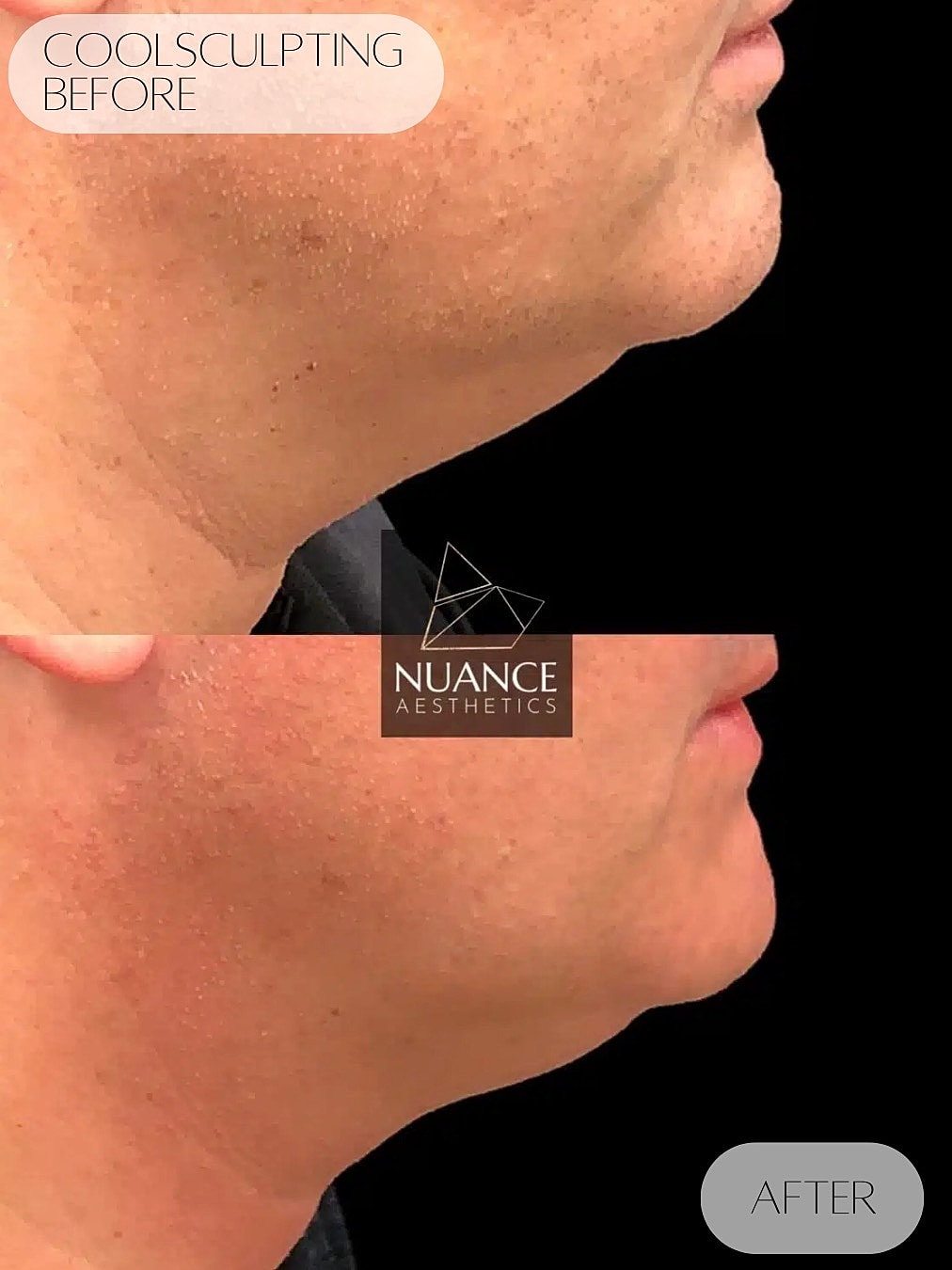 Coolsculpting Before & After