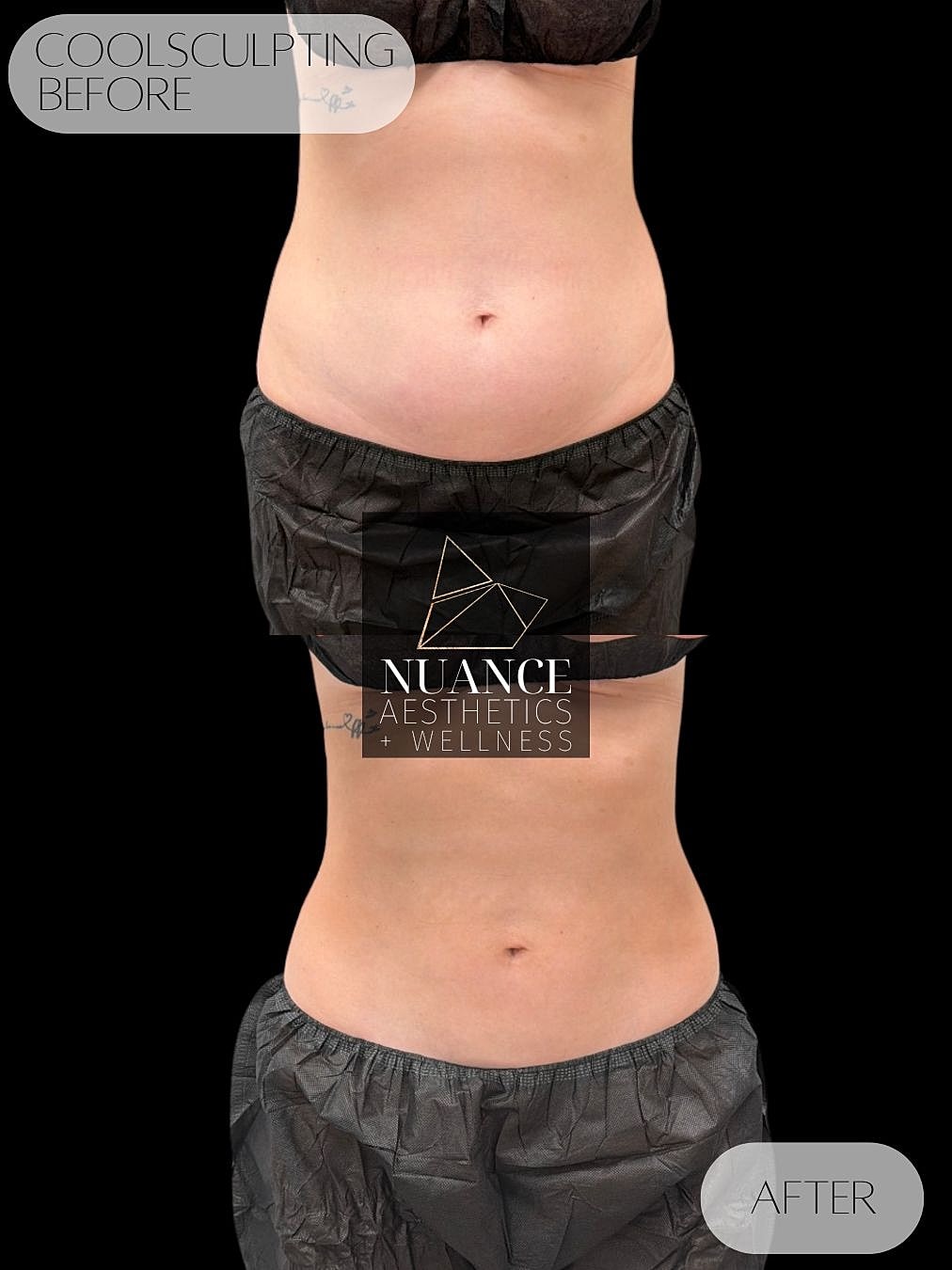 CoolSculpting® Before & After