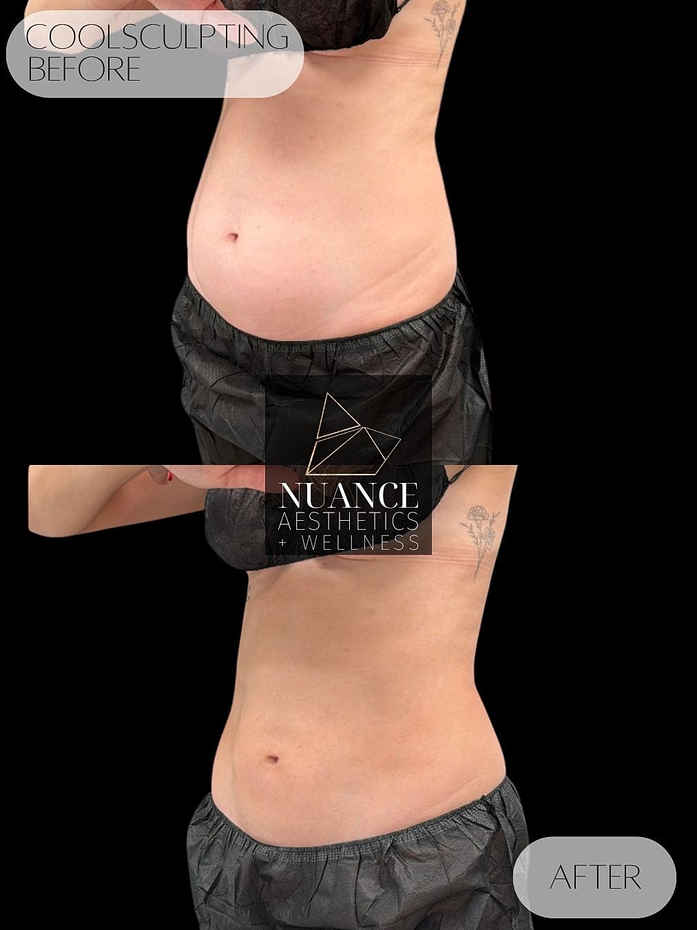 CoolSculpting® Before & After