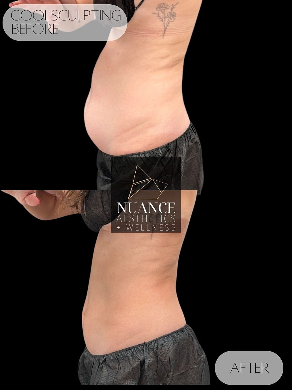 CoolSculpting® Before & After