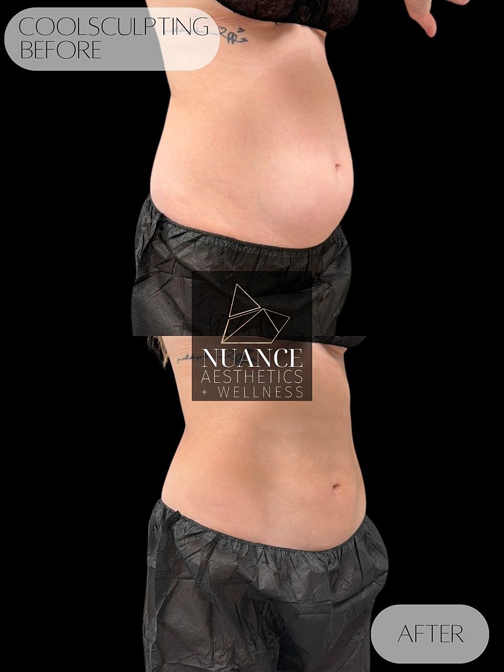 CoolSculpting® Before & After