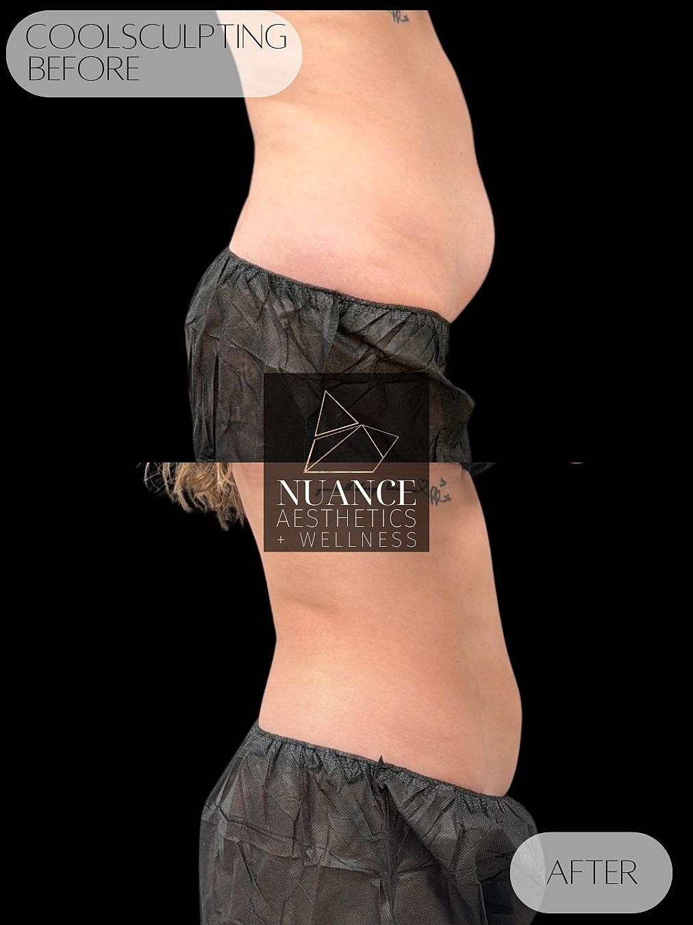 CoolSculpting® Before & After